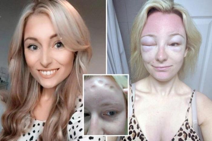 Девушка поделилась фотографиями своей ужасной реакции на активное солнце