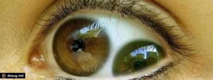 Бывает ли двойной. Поликория аномалия глаз. PUPULA Duplex двойной зрачок.