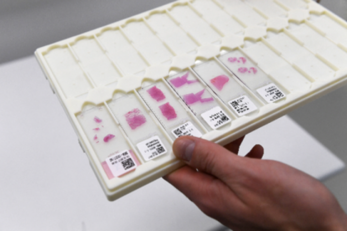 Ученые разработали технологию выявления рака на ранней стадии