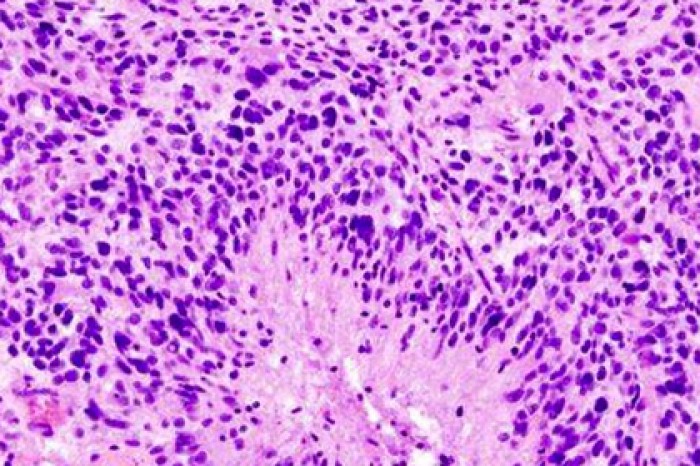 Доказана эффективность вакцины против рака мозга