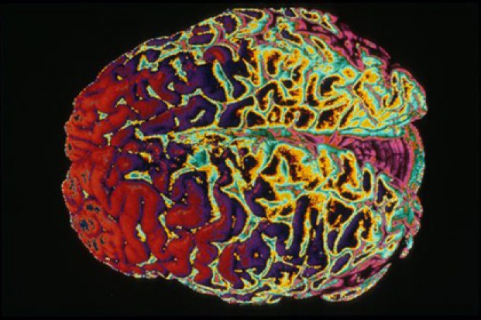 Создана разрушающая человеческий мозг молекула-убийца