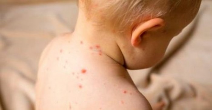 Число заболевших корью детей увеличилось до 71