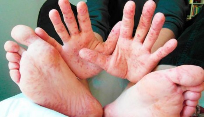 Прививки необходимы: врачи призывают родителей не отказываться от вакцинации детей