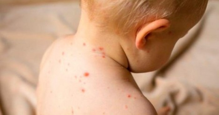 Комиссия по здравоохранению обсудит ситуацию с корью в стране