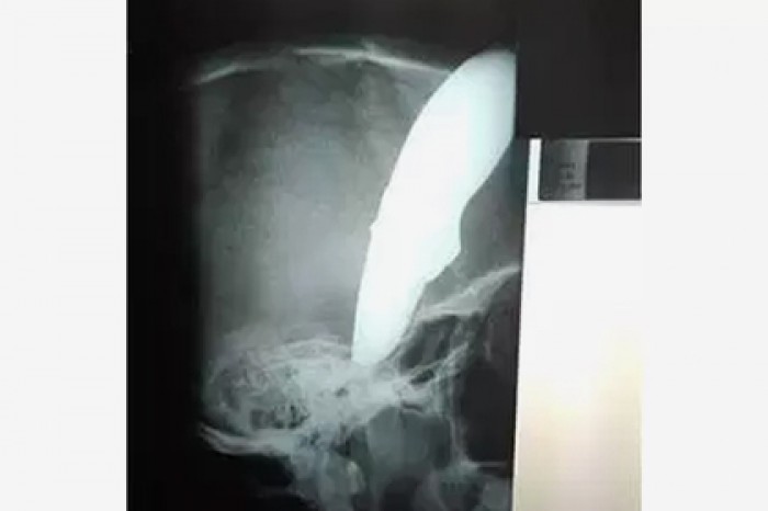 Велосипедист с ножом в голове отбился от преступников и сам приехал к врачу