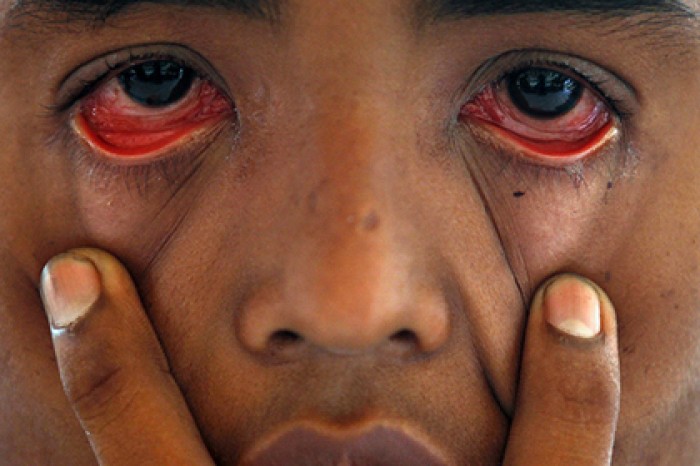 В глазах людей нашли смертельно опасные белки-«зомби»