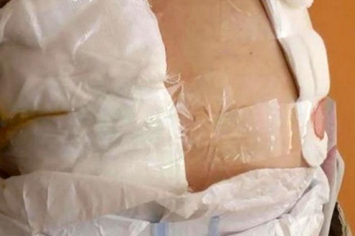 Чиновники пообещали не увольнять медсестру за перевязку пациента скотчем