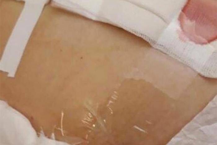 Главврача российской больницы уволили за перевязку пациентов скотчем