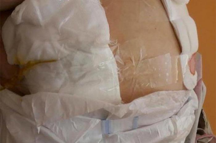 Нехватка лейкопластыря вынудила врачей перевязывать пациентов скотчем