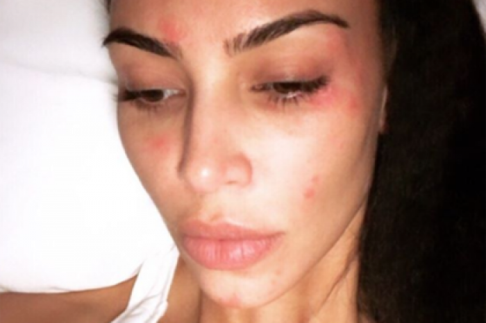 Ким Кардашьян показала прогрессирующее кожное заболевание на фото без макияжа
