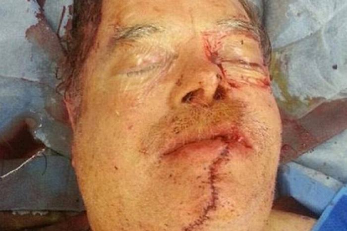 Мужчина распилил себе лицо бензопилой и сам добрался до врачей