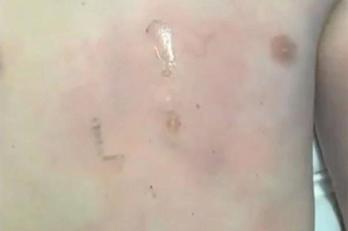 Аккумулятор от iPhone взорвался в руках у школьника