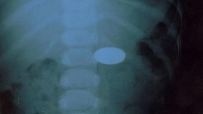 Столичные врачи спасли подавившегося монетой ребенка