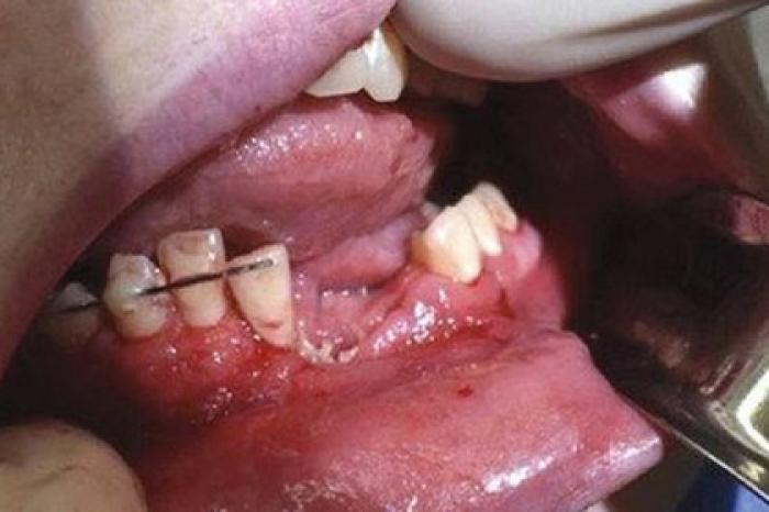 Электронная сигарета взорвалась во рту подростка и лишила его зубов