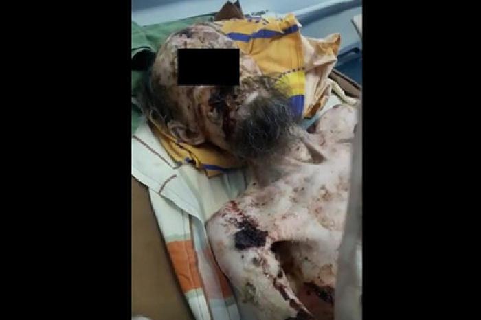 Восставший из могилы житель Сочи оказался страдающим от псориаза казахстанцем