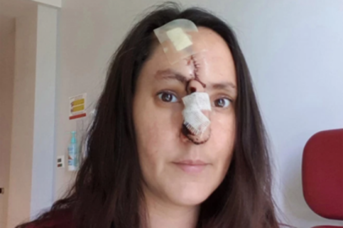 Женщина принимала рак за царапину и лишилась носа