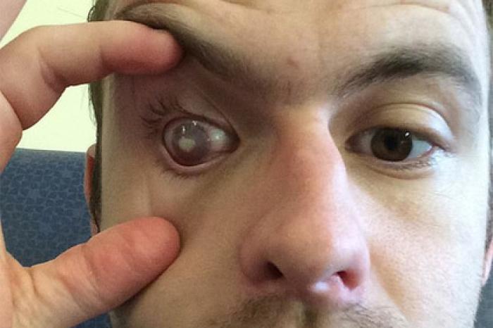 Мужчина принял душ в линзах и ослеп на один глаз