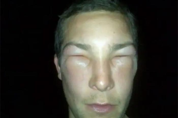 Популярный ведущий оказался при смерти после укуса пчелы