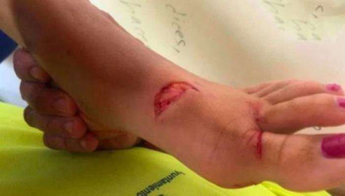 В Испании луфарь разорвал сухожилия купавшейся в море женщине