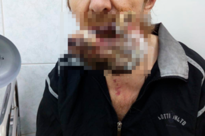 Россиянин ушел в тайгу лечить рак молитвами и вернулся с гигантской опухолью