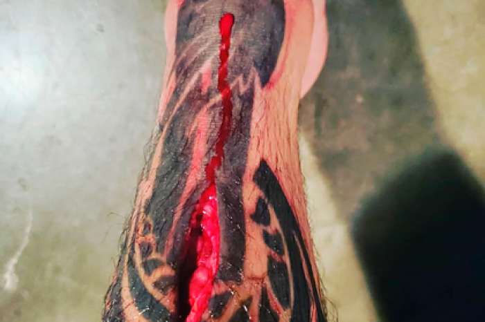 Фото кровавой раны бойца UFC после поединка испугало фанатов
