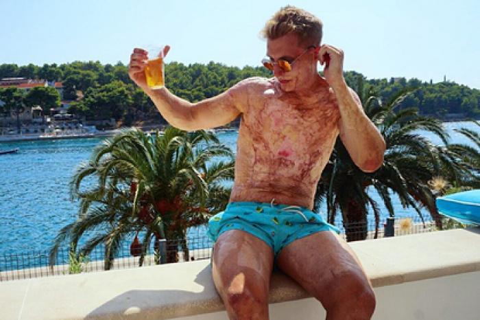 Участник телешоу показал пораженное шрамами после мощного удара током тело