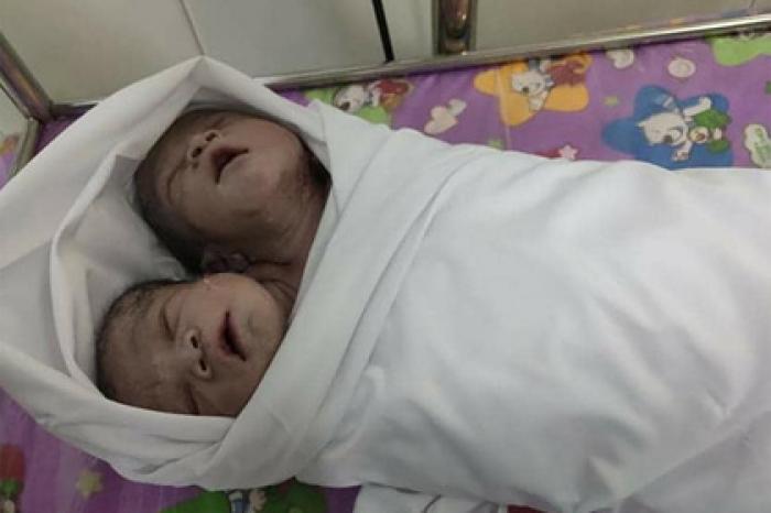 Родился полностью здоровый ребенок с двумя головами