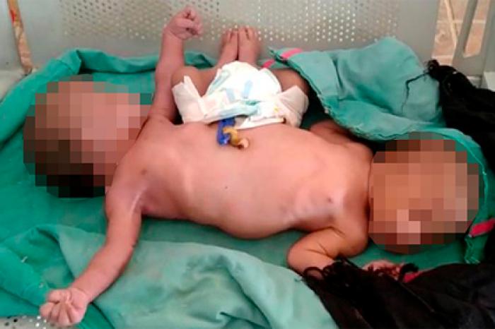 Сиамские близнецы родились с двумя ногами и четырьмя руками
