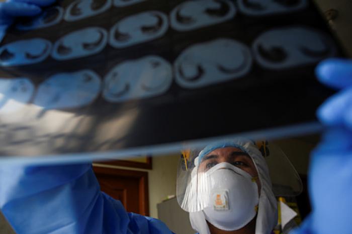 Врач назвал способ отличить коронавирус от рака легких