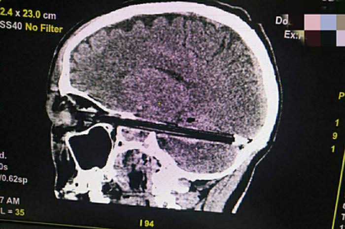 Врачи спасли россиянина с застрявшей в мозгу шариковой ручкой