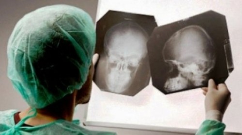 Мужчина десять лет прожил с карандашом в голове