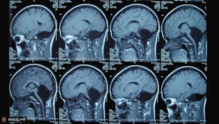 У 24-летней девушки врачи не нашли мозжечок