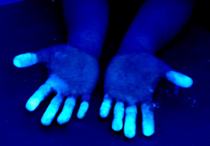 Раскрыт механизм предотвращения рака ультрафиолетом