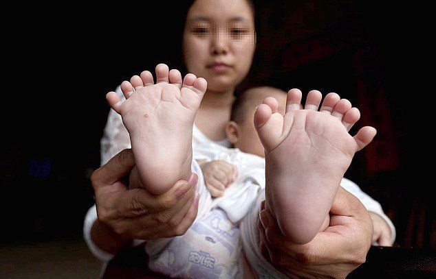 В Китае родился мальчик у которого 31 палец