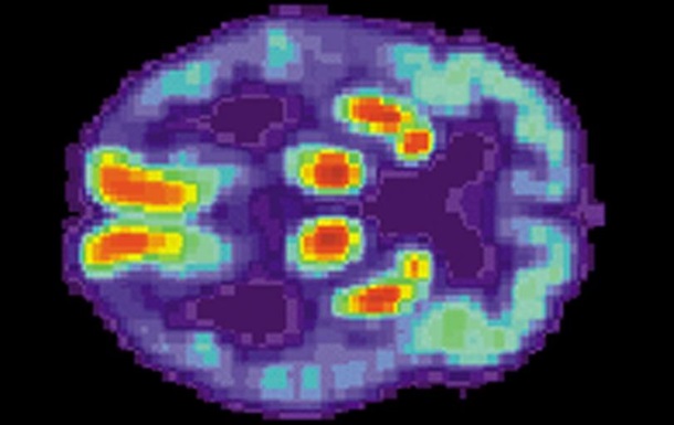 Ученые получили новые данные о болезни Альцгеймера