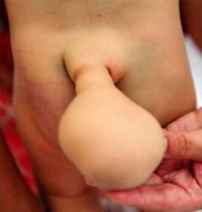 Ребенок родился с опухолью в виде хвоста